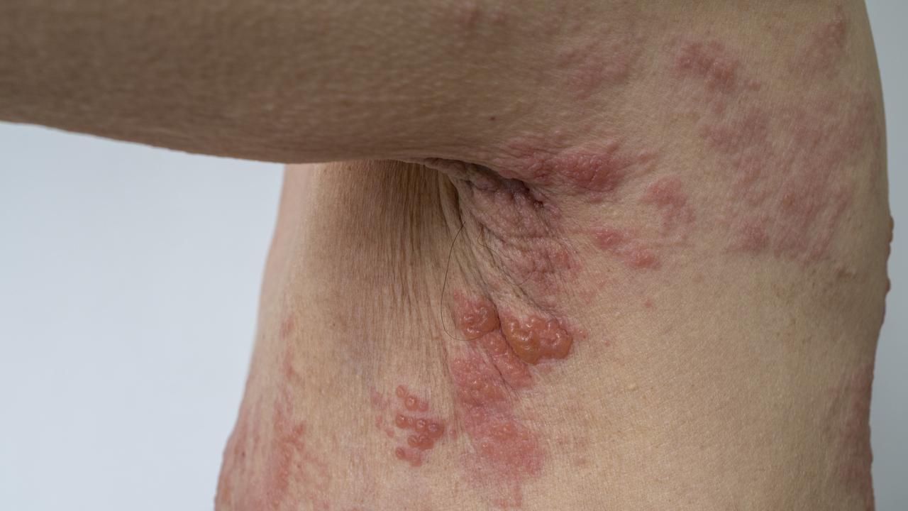 The rash caused by a case of Shingles