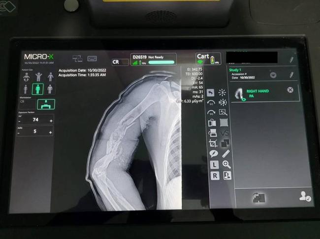 An X-ray showing the exit wound from a shot Ukrainian soldier taken on an Australian Micro-X Rover unit. Source: Micro X