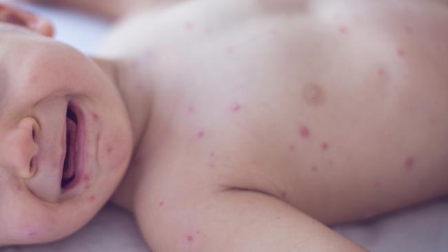 New Zealand‘s outbreak of measles has affected more than 1000 children so far. Picture: iStock