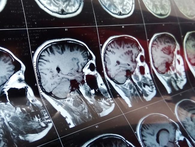 Magnetic resonance scan of the brain with skull. MRI head scan on dark background blue color. X-ray medicine and medication concept