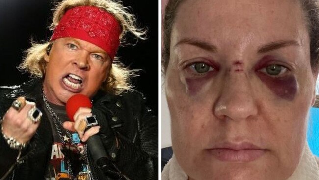 The woman says she suffered severe facial injuries at the Guns N' Roses concert. Picture: Supplied