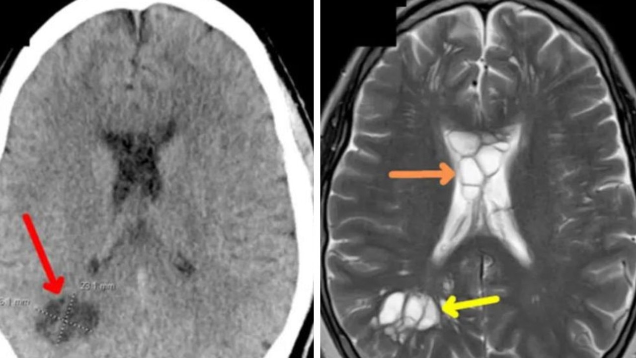 A worm was found in a US man’s brain after he ate undercooked bacon. Picture: American Journal of Case Reports