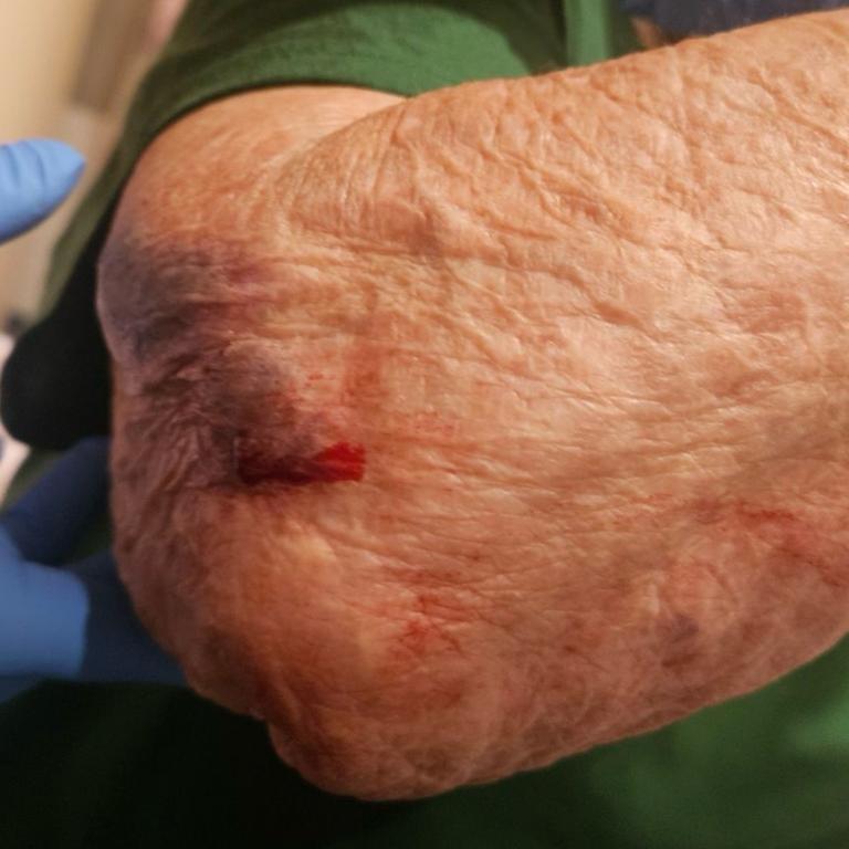 One aged care resident suffered injuries after falling getting on a bus without help. Picture: Supplied