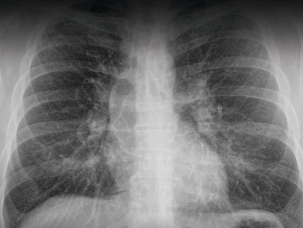 University of Queensland wins $600k grant to help dust-lung injured get ...