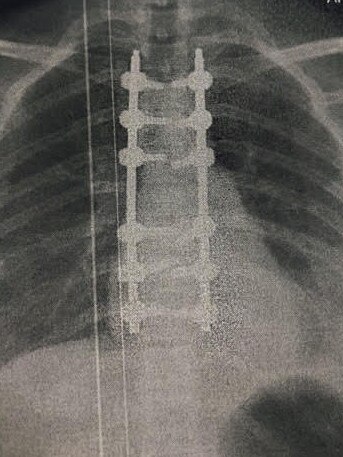 An xray showing Christina’s spinal injuries.