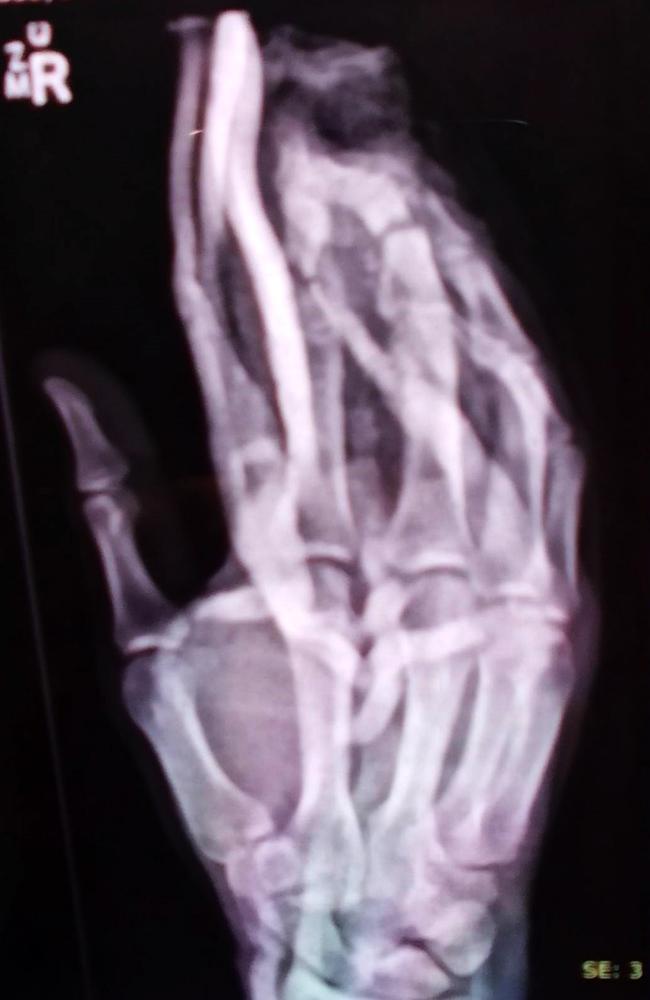 X-ray of Jay Mobbs injured hand that was crushed by a log splitter in a workplace incident.