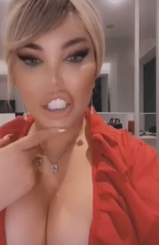 She said product has been ‘pouring out of her chin’ following the procedure at a hair salon in Essex, UK. Picture: Instagram/Jessicaalvesuk