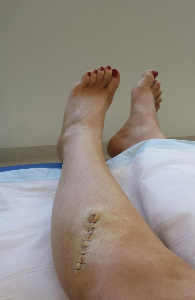 Jess Pasco's leg after her melanoma was removed.