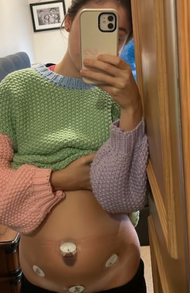 Ms Forster was diagnosed with endometriosis at 22 years old. Picture: Supplied