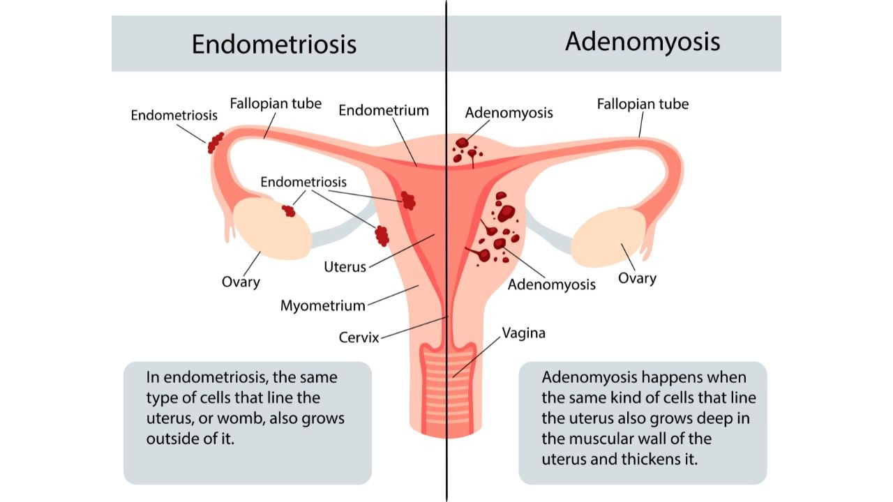 While referred to as the "bad cousin" of endometriosis, adenomyosis is a distinctly different condition. Picture: iStock.