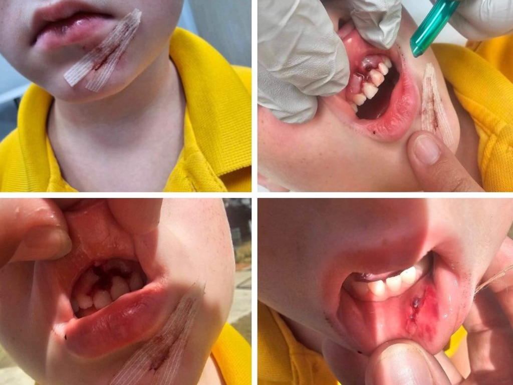 Prep student Xander had emergency dental surgery to remove the teeth stuck in his gum as a result of his playground accident on March 5, 2024.