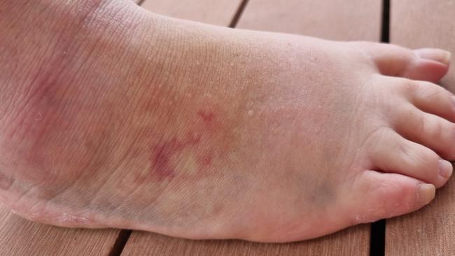 Diana Reed's foot remained swollen and bruised for months after the incident. Picture: Supplied