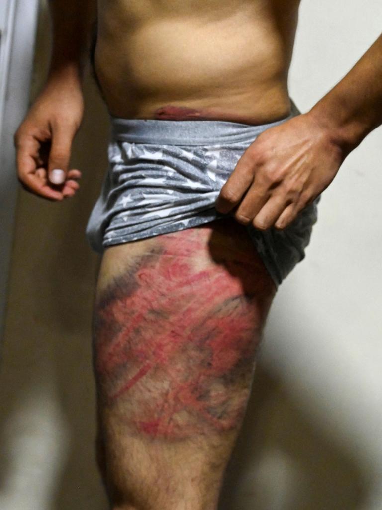 Nematullah Naqdi shows wounds on his leg. Picture: Wakil Kohsar/AFP