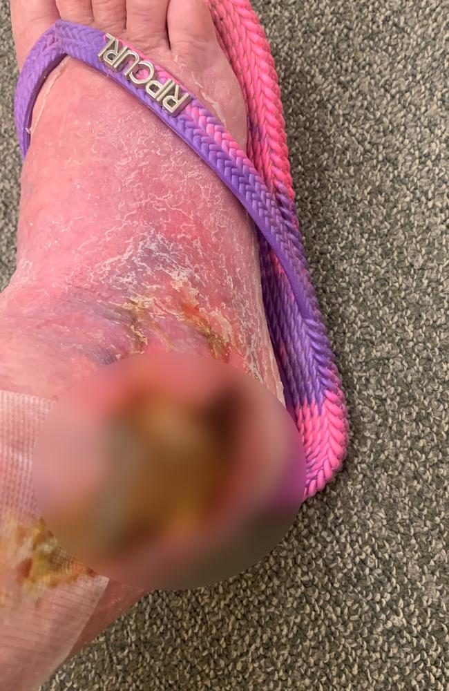 Anne Hunt's Buruli ulcer now. Picture: Supplied