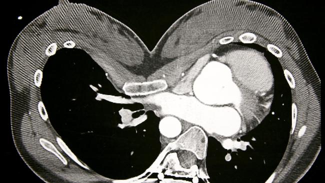 A CT scan demonstrating displacement of Jasmin’s heart into the far left side of her chest