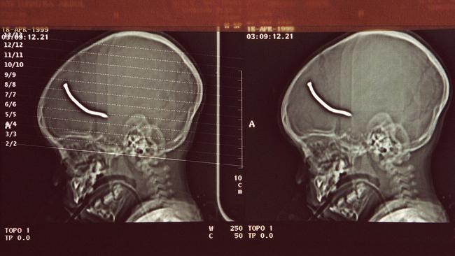 Copy of CAT scan released by London's Great Ormond Street Children's Hospital, showing the head of a 23-month-old child who was injured in nail bomb explosion in Brixton, South London, in 1999.