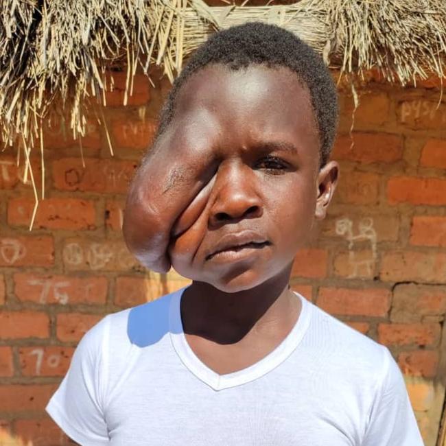 Elinah’s facial tumour could not be dealt with in her home country of Zambia.