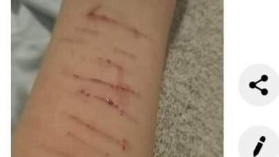 A Gold Coast teenager who was in foster care is now homeless - the cuttings on her arm has sparked concerns among those who had supported here.