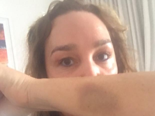 Kate Langbroek with bruise she sustained after she was attacked in her St Kilda home on March 2. Twitter: @MartinFoleyMP Thanks for your call yesterday. This is the bruise I sustained trying to keep that “vulnerable” resident from kicking our front door in on Friday night. Children inside. The real vulnerable are the decent citizens of St Kilda. We await your action.