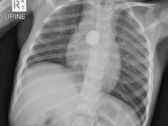 An x-ray showing a button Batter y inside Shaylah Carmichael .  Shaylah  swallowed a button battery when she was five years old. Her mum, unaware of what happened, took her to the doctors five times before eventually being referred to a paediatrician.