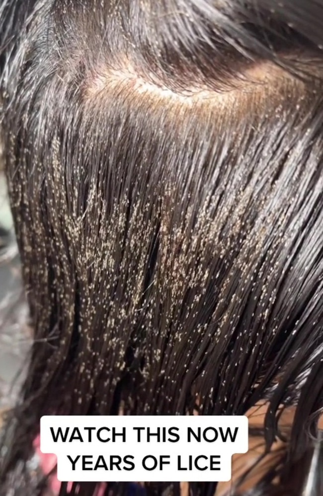 Woman’s head teaming with bugs after five years of head lice | Video ...