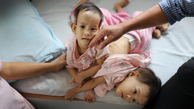 Paediatric surgeon Dr Karma Sherub checks over the twins at the Jigme Dorji Wangchuck National Referral Hospital in Thimphu. Picture: Alex Coppel