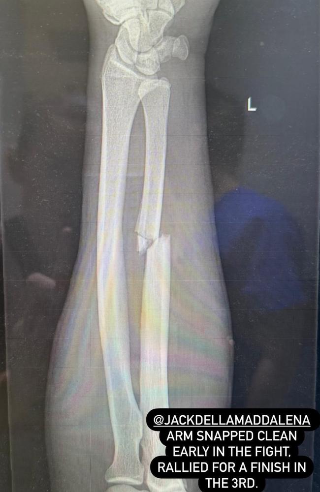 X-rays revealed Della Maddalena suffered a clean broken arm. Picture: Supplied/Instagram