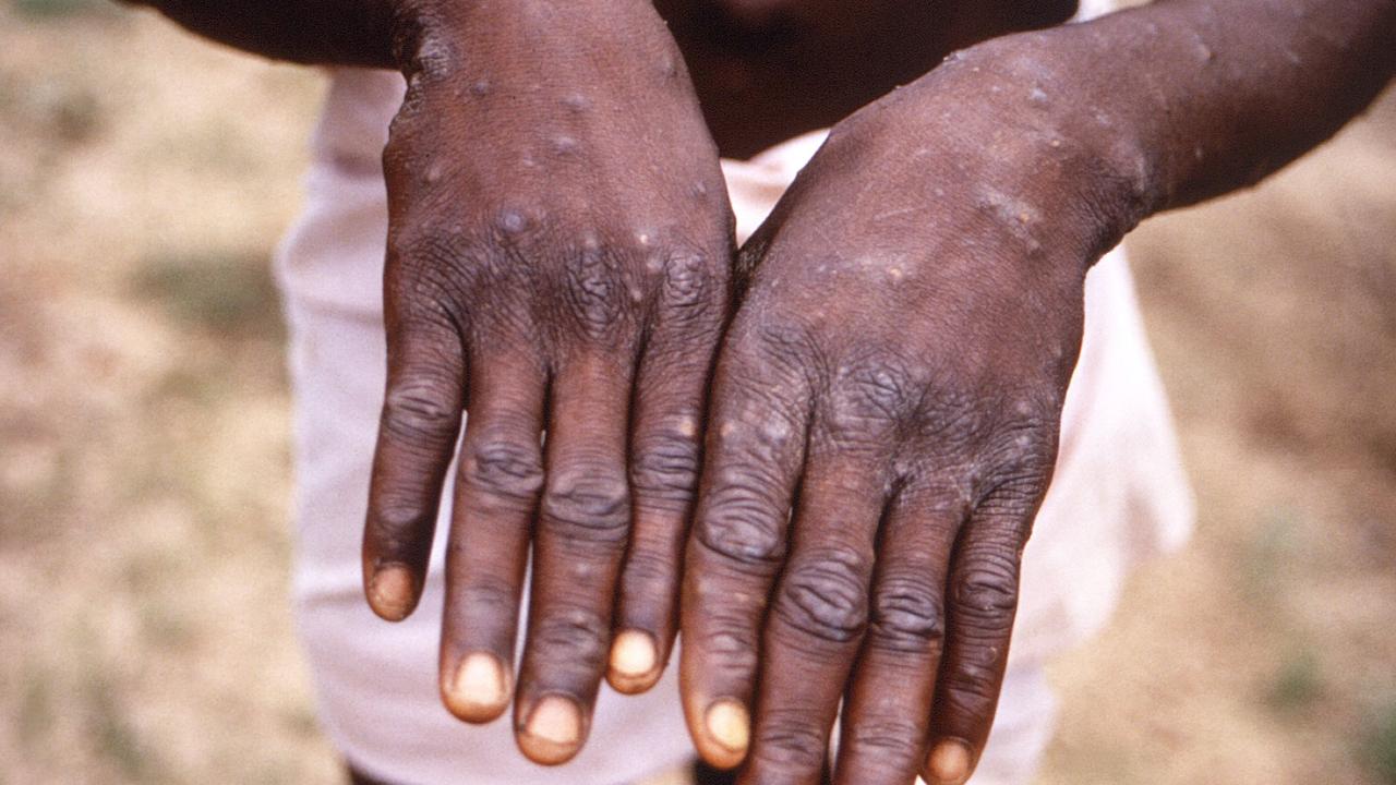 Monkeypox presents as a rash over the body. Picture: Brian W.J. Mahy/Centers for Disease Control and Prevention/AFP